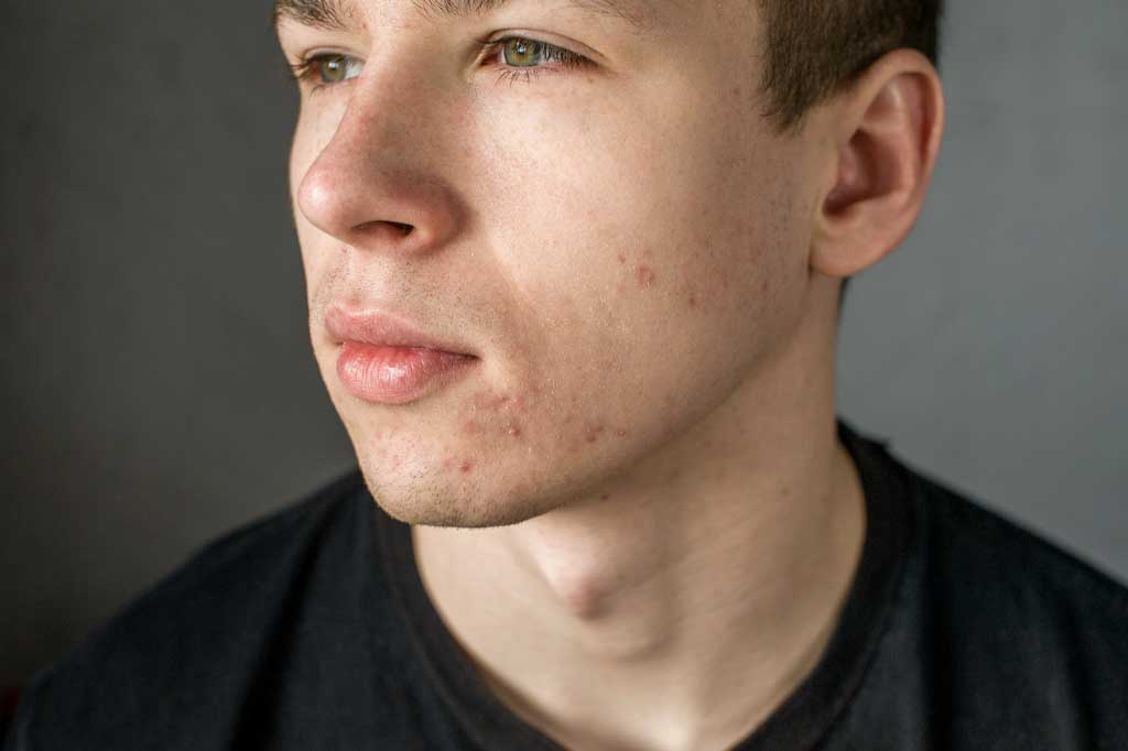 Young man with acne
