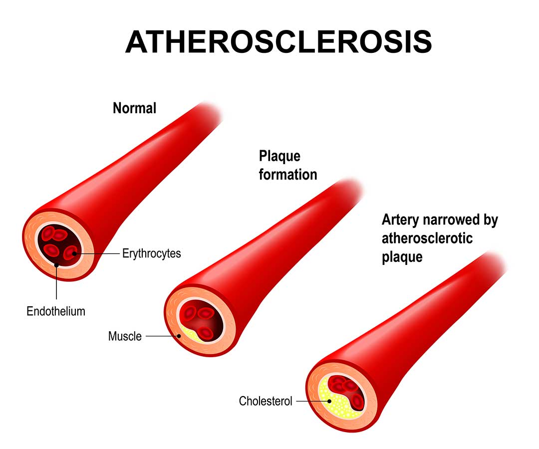 Graphic of Atherosclerosis in arteries