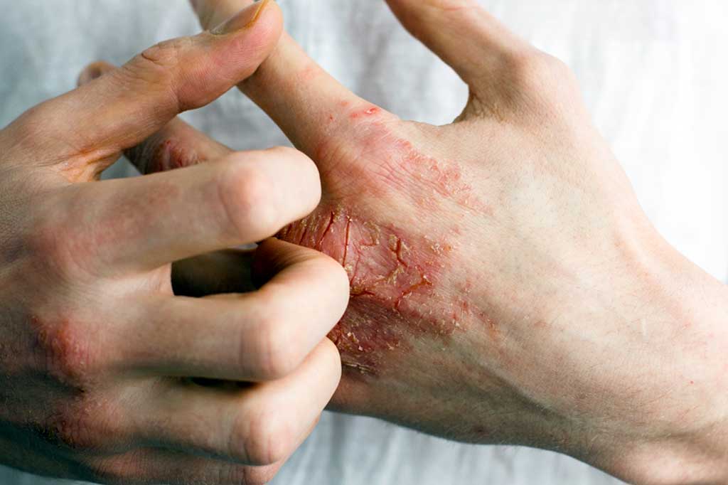 Close up of hands with eczema