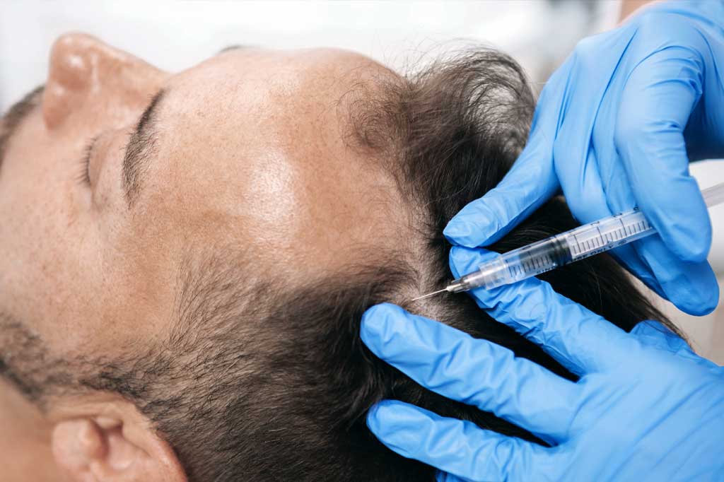 Man receiving Hair Loss Restoration Treatment