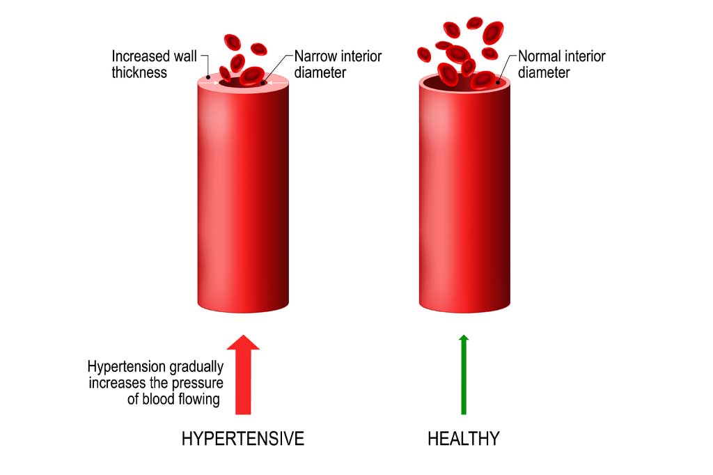 Blood vessels with hypertension graphic