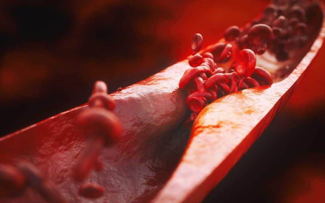 Graphic rendering of arteries with atherosclerosis