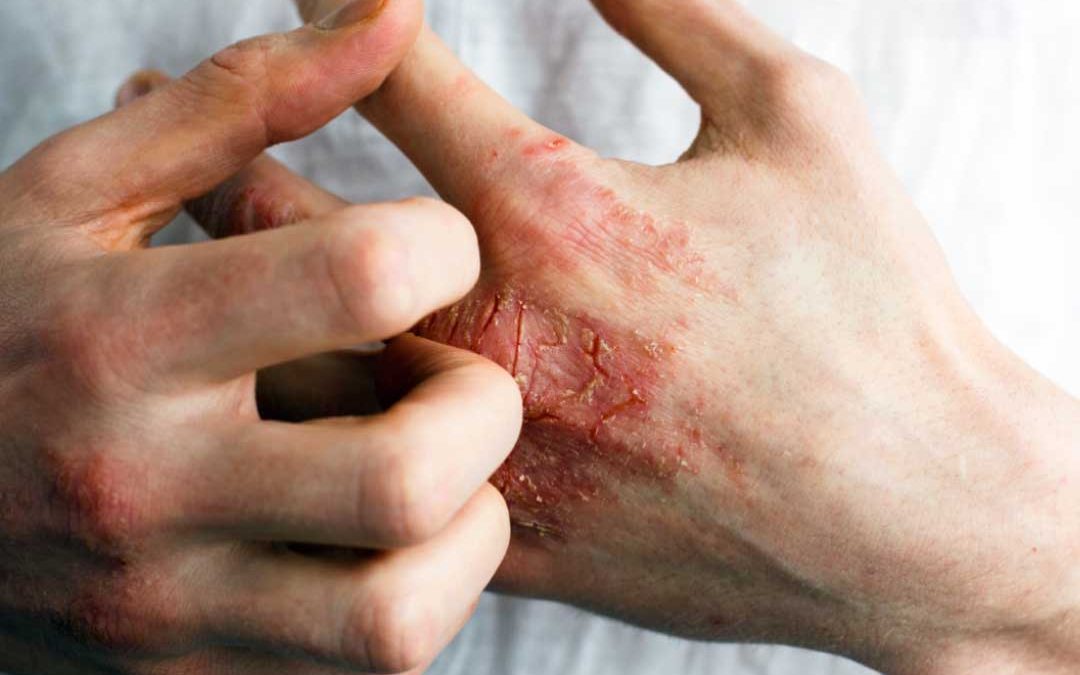 Close-up of man's hands scratching his eczema