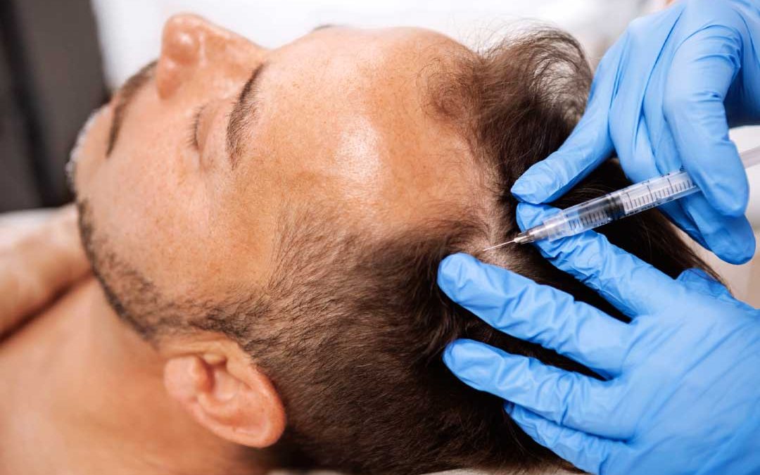 Close-up of a man receiving hair loss treatment injections in the scalp by a professional.